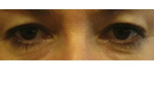 Manhattan BLEPHAROPLASTY Before 2